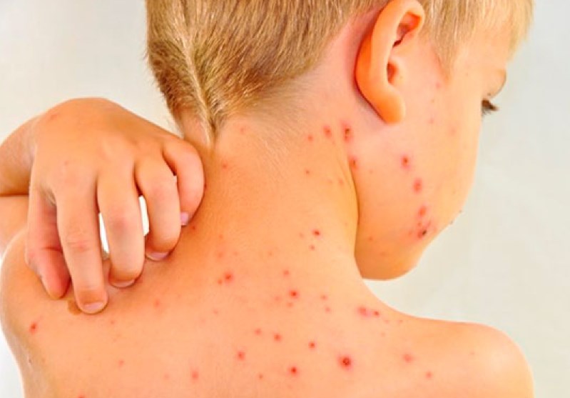 Кір : симптоми, причини